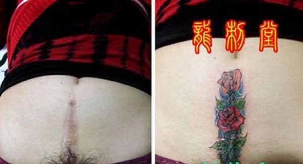 女性剖腹产疤痕玫瑰花图案遮盖纹身